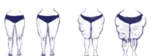 I quattro stadi del lipedema agli arti inferiori